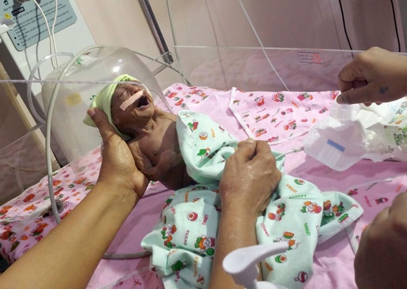 TD.Newborn Astonishes with Appearance of 70-Year-Old Man at Birth