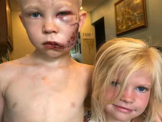 TD."A Brave Six-Year-Old Risks His Life to Shield Younger Sister from Vicious Dog Attack, Expresses: 'She Shouldn't Have Been the One Injured'"