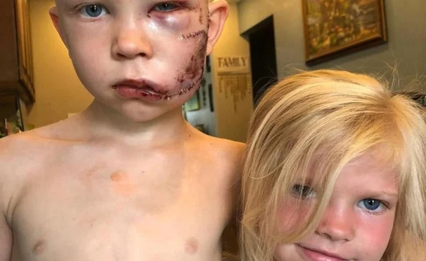 TD."A Brave Six-Year-Old Risks His Life to Shield Younger Sister from Vicious Dog Attack, Expresses: 'She Shouldn't Have Been the One Injured'"